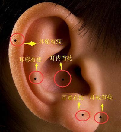 耳朵裡面長痣|耳朵痣位置：影響健康？